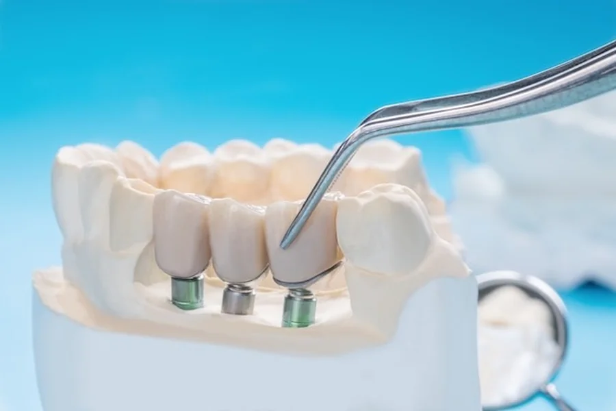 Choosing Between Dentures And Implants What’s Right For You